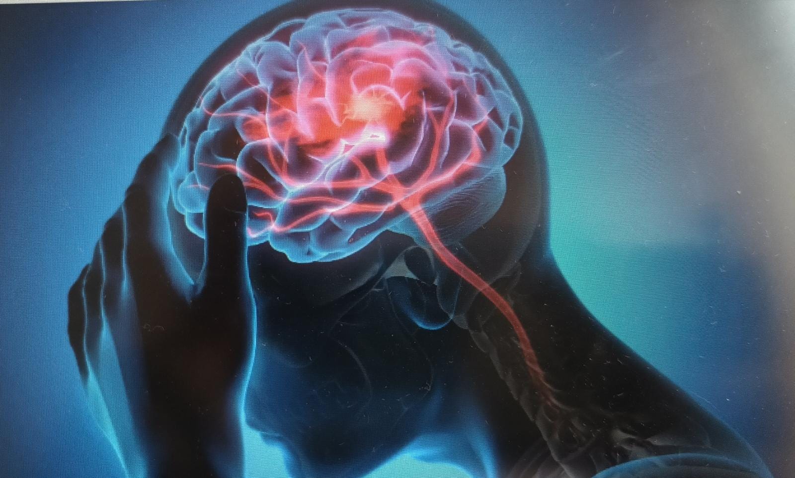 Understanding Stroke: Definition, Symptoms, Risk Factors, Diagnostics, and Treatment