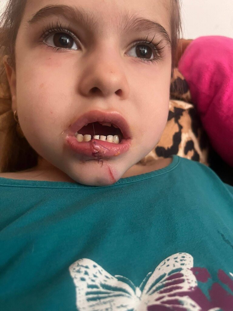 Copil desfigurat la grădiniță în Vâlcea: Dosar penal