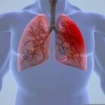 Semnele tuberculozei. Unde faci testări în Craiova