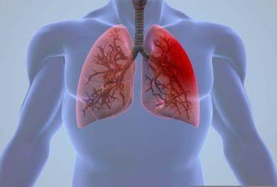 Semnele tuberculozei. Unde faci testări în Craiova