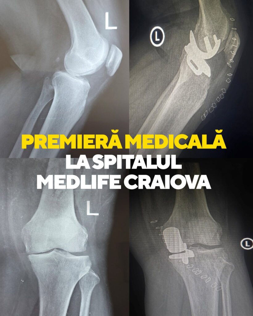 Premieră în Oltenia: Proteză de genunchi Oxford - Jurnalul Olteniei – Știri din Craiova și Oltenia Premieră în Oltenia: Proteză de genunchi Oxford