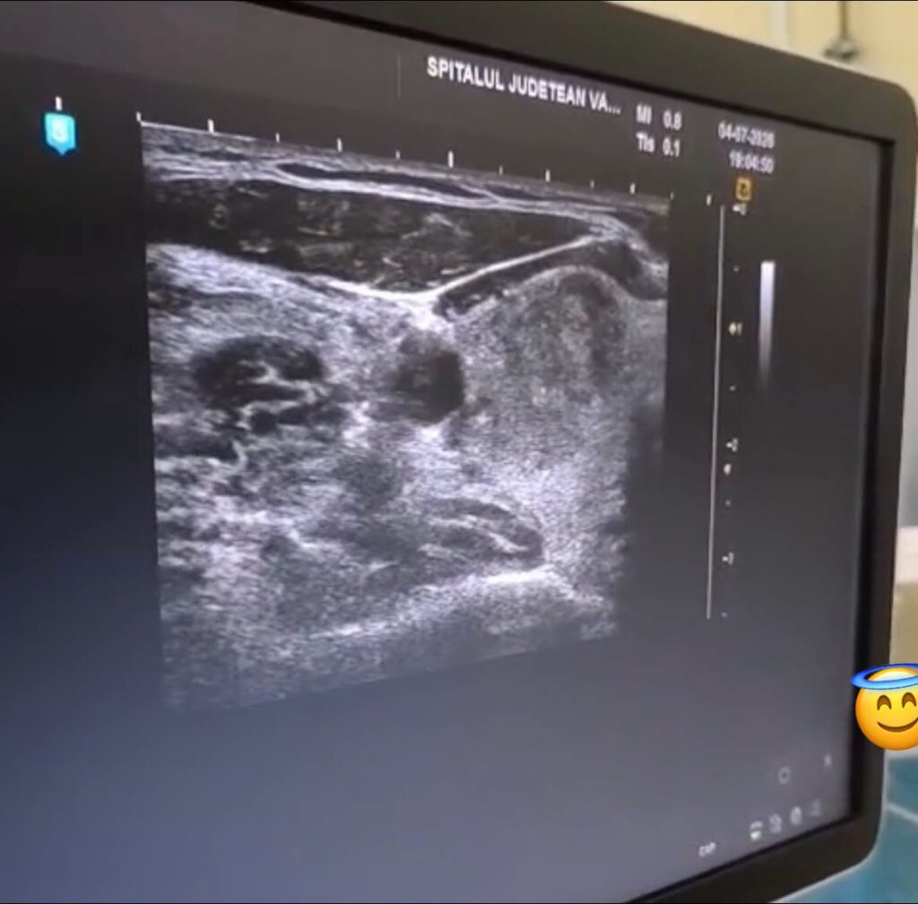 Premieră medicală la SJU Vâlcea pentru nodulii tiroidieni