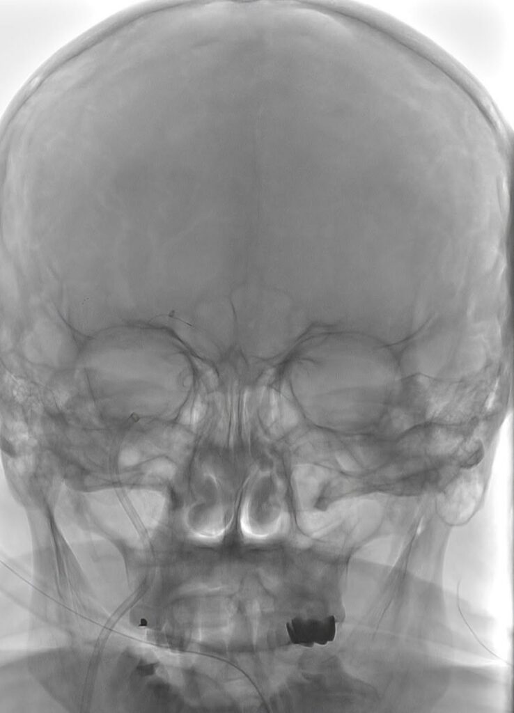 Fiecare minut contează: 20 de trombectomii la SCJU Craiova - Jurnalul Olteniei – Știri din Craiova și Oltenia Fiecare minut contează: 20 de trombectomii la SCJU Craiova