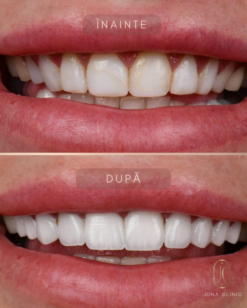 WhatsApp Image 2026-08-07 at 131514 1 - Jurnalul Olteniei – Știri din Craiova și Oltenia Before and after dental veneer treatment: upper front teeth show staining and chips, now replaced with bright, even veneers in the lower image.