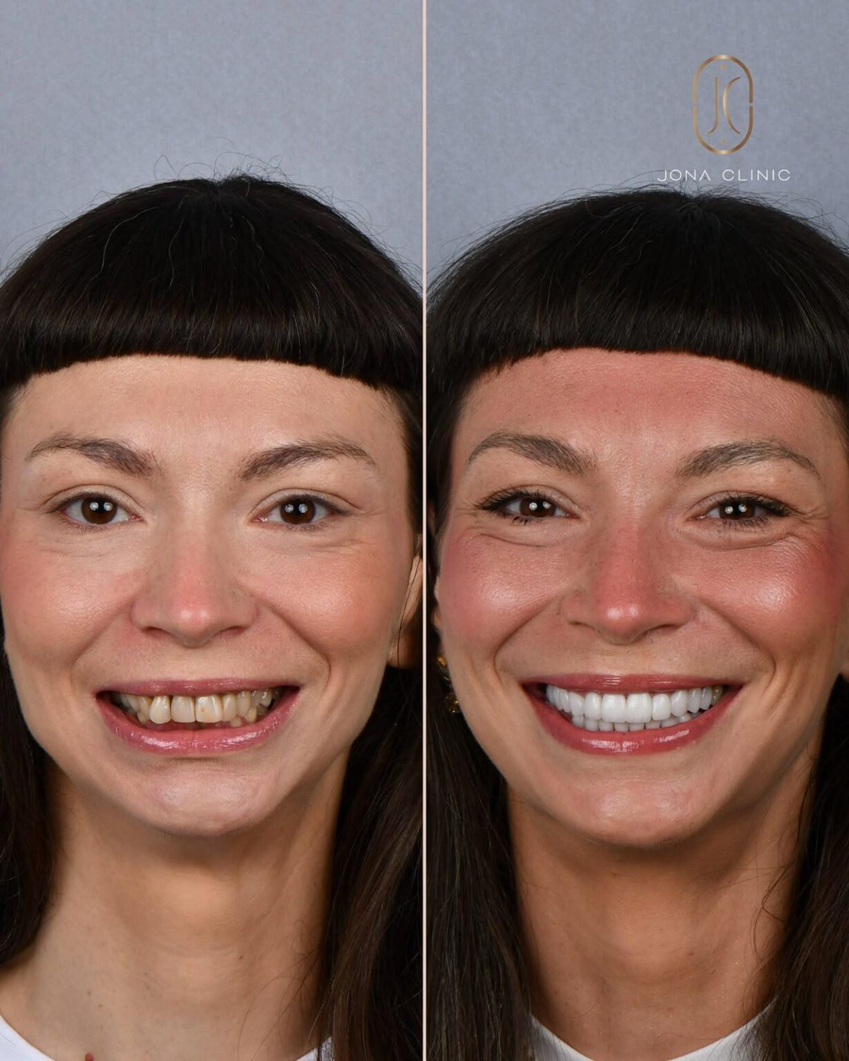 WhatsApp Image 2026-08-07 at 131514 5 - Jurnalul Olteniei – Știri din Craiova și Oltenia Before and after: woman's smile improved with whitening and alignment; left shows yellowed, crooked teeth, right shows bright, straight teeth.