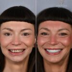 Before and after: woman's smile improved with whitening and alignment; left shows yellowed, crooked teeth, right shows bright, straight teeth.
