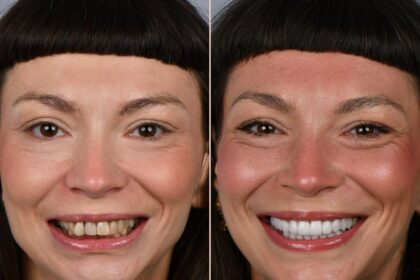 Before and after: woman's smile improved with whitening and alignment; left shows yellowed, crooked teeth, right shows bright, straight teeth.
