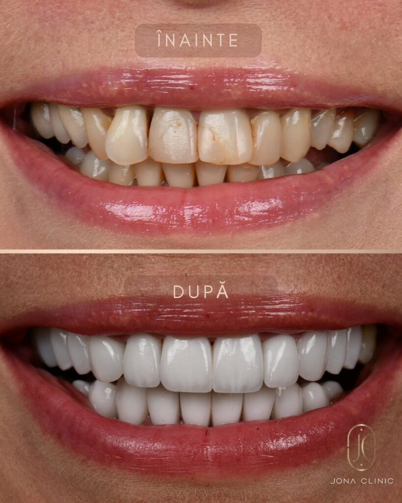 WhatsApp Image 2026-08-07 at 131514 - Jurnalul Olteniei – Știri din Craiova și Oltenia Before and after dental whitening: top half shows yellowed, uneven front teeth; bottom half shows evenly white, straight teeth after treatment.